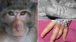 Cần biết: 6 biện pháp phòng chống dịch bệnh đậu mùa khỉ