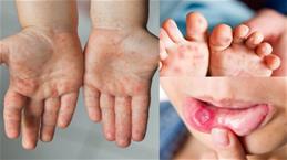 Thông tin mới nhất về bệnh tay chân miệng ở nước ta, 6 khuyến cáo cần nhớ của Bộ Y tế