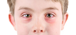Nhiều trẻ gặp biến chứng nặng do đau mắt đỏ, chuyên gia khuyến cáo gì?