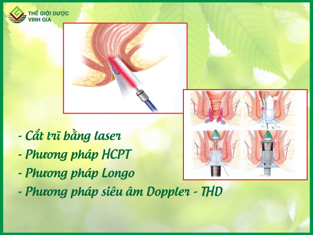 Một số phương pháp phẫu thuật phổ biến hiện nay là Laser, HCPT, Longo, siêu âm Doppler