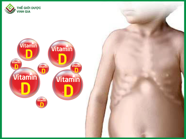 Có phải thiếu vitamin D trẻ em sẽ mắc bệnh còi xương?