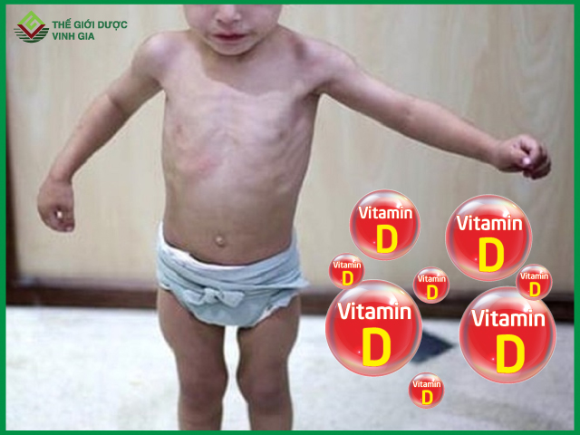 Nguyên nhân chủ yếu khiến trẻ còi xương là do thiếu vitamin D