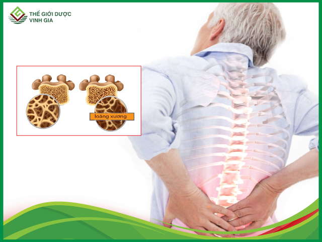 Triệu chứng loãng xương dễ thấy nhất là những cơn đau nhức đầu xương