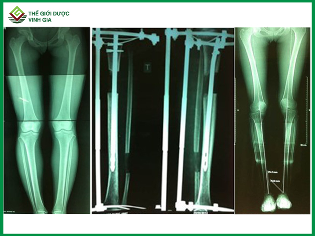 Hình ảnh X-quang trước và sau khi thực hiện ca phẫu thuật tăng chiều cao