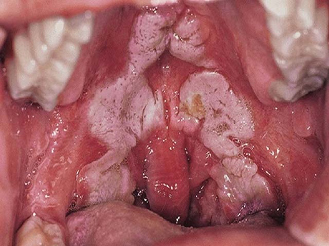 Bệnh bạch hầu là một bệnh nhiễm trùng nhiễm độc do trực khuẩn bạch hầu gây ra (Corynebacterium diphtheria)