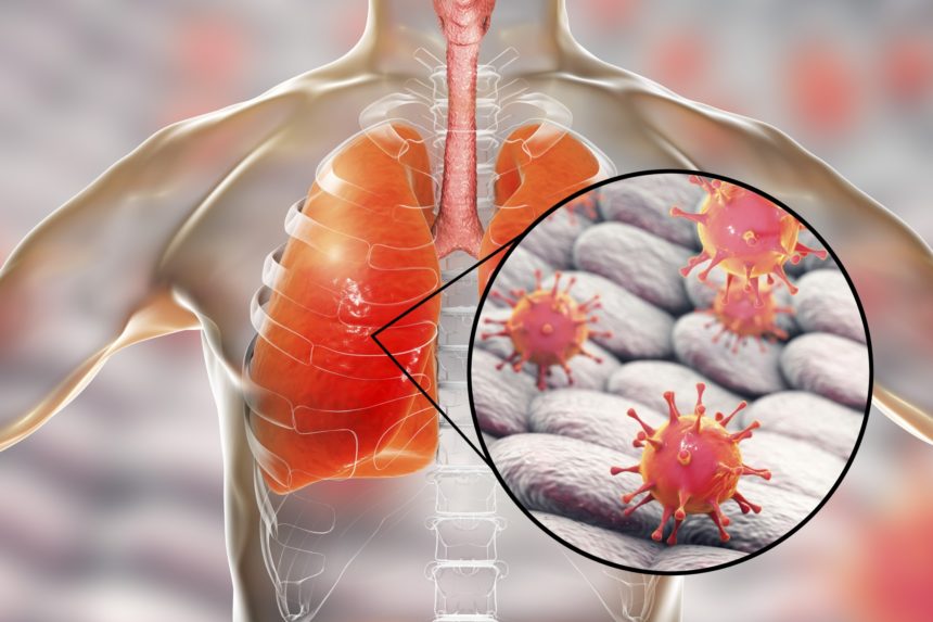 Virus tấn công đường hô hấp gây bệnh phổi có thể dẫn tới tử vong