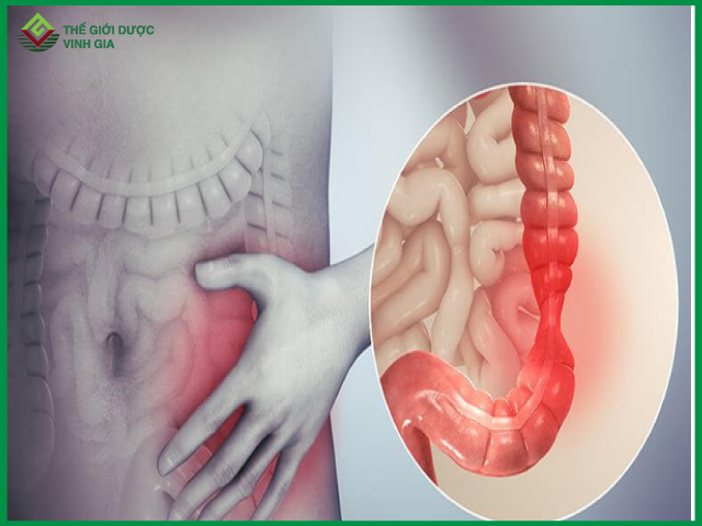 Các bệnh lý liên quan đến hiện tượng nổi cục ở bụng dưới bên trái