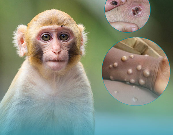 Theo Bộ Y tế, bệnh đậu mùa khỉ có các triệu chứng chính là sốt, phát ban dạng phỏng nước và sưng hạch ngoại vi, có thể gây biến chứng nặng dẫn tới tử vong.