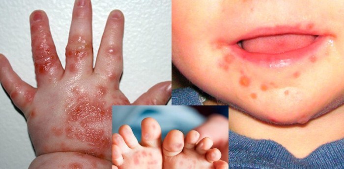Bệnh tay chân miệng chủ yếu xảy ra ở trẻ em dưới 10 tuổi, thường là ở trẻ nhỏ dưới 5 tuổi. Trẻ càng nhỏ thì các triệu chứng càng nghiêm trọng hơn.